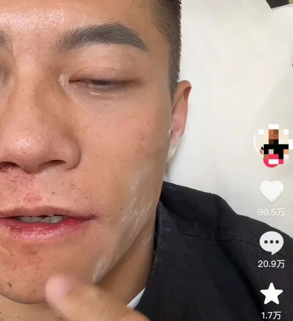 快牛策略 看着都疼！中国选手参加世界扇耳光大赛倒地受伤，本人回应